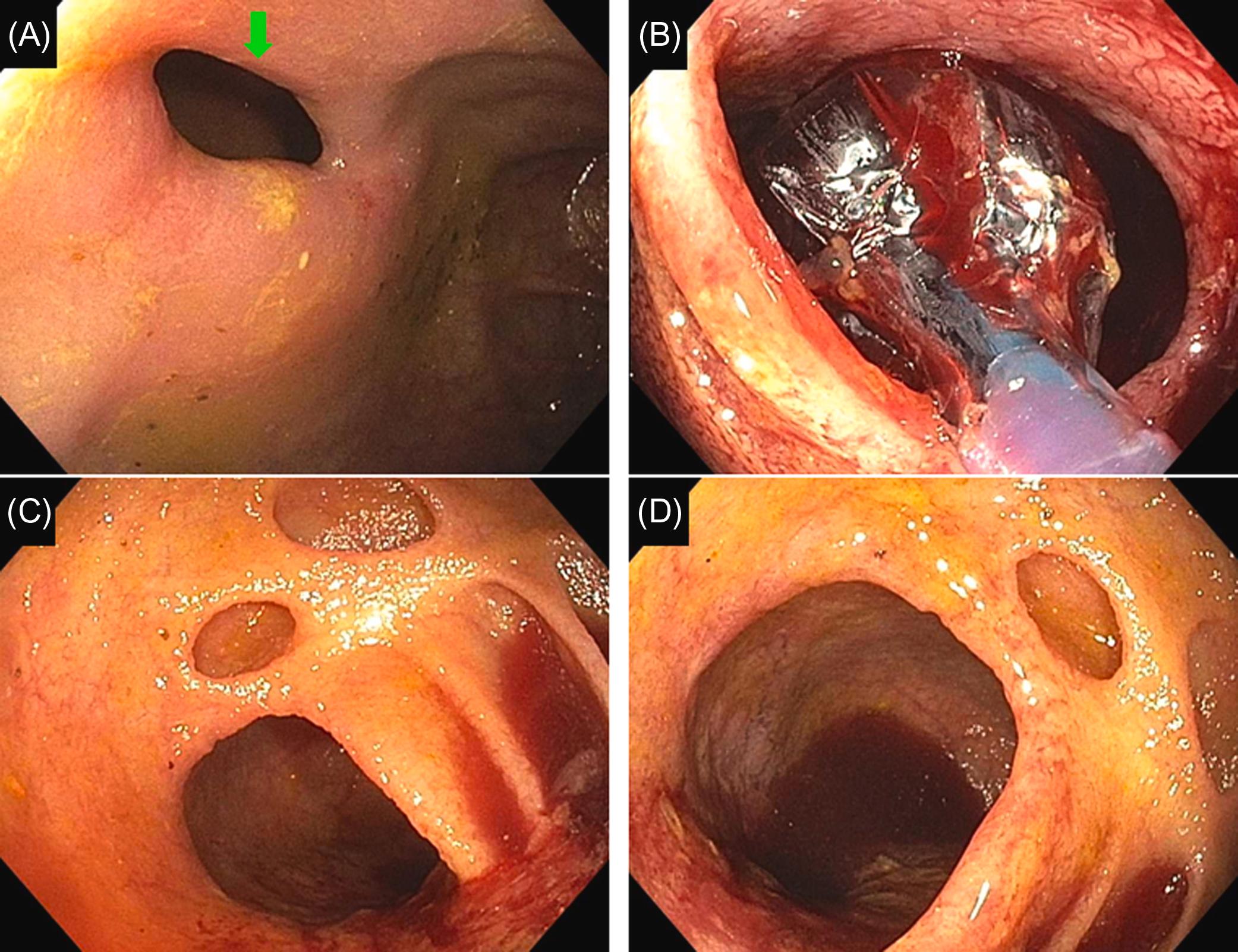 Figure 29.10, Nonsteroidal antiinflammatory drug-induced ileocecal valve stricture and diverticuli of the ileum in a patient with small bowel Crohn’s disease before the initiation of medical therapy: (A) A short ileocecal valve nonulcerated stricture ( green arrow ); (B) endoscopic balloon dilation of the stricture; (C) and (D) prestenotic dilation of the lumen of the terminal ileum and diverticuli found after endoscopically dilating and traversing stricture.