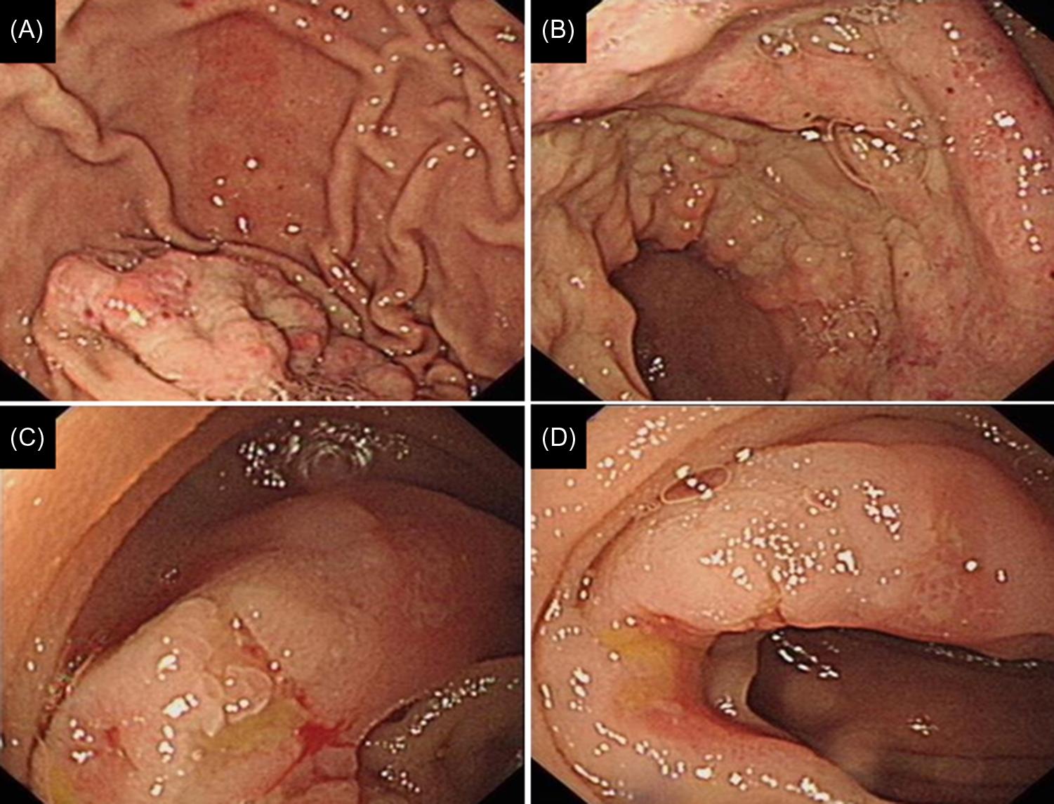 Figure 32.1, Eosinophilic gastroenteritis. (A) Patchy erythema at the gastric body and nodularity of the gastric antrum and (B–D) similar patterns with mucosal edema and nodularity of the colon.