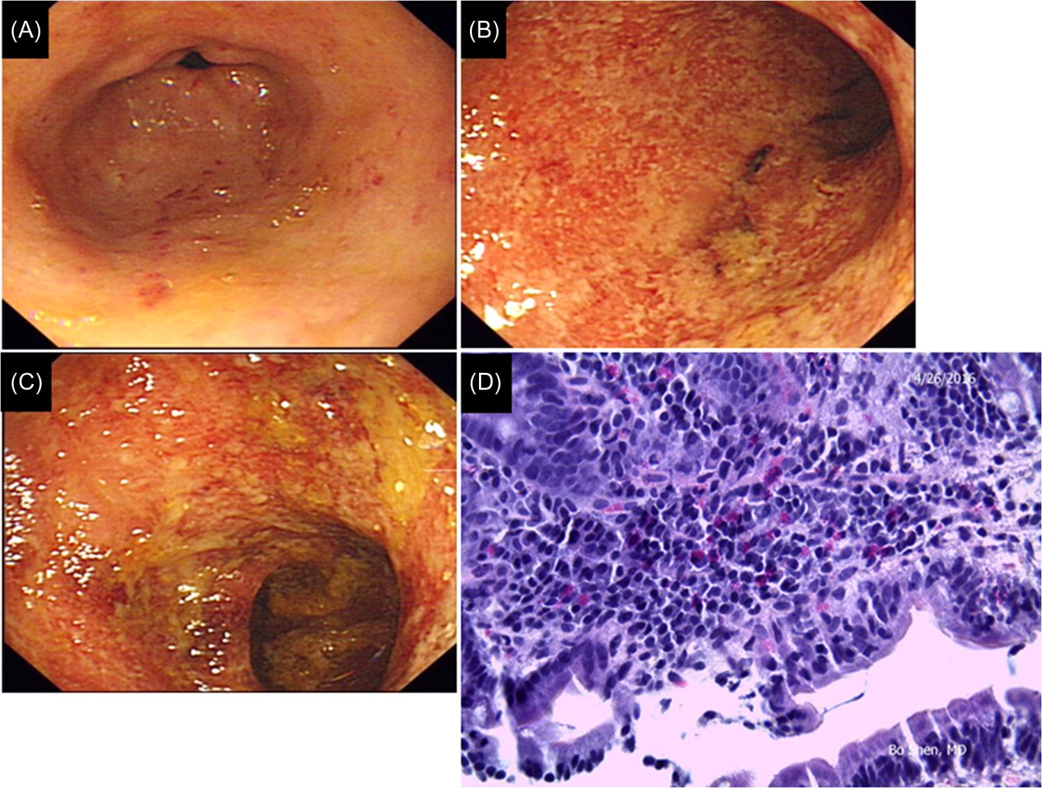 Figure 32.2, Eosinophilic gastroenteritis involving colon. (A) Gastritis with linear erythema and loss of vascularity of mucosa; (B and C) hyperemia, edema, and erosions of colon mucosa; and (D) histopathology showed inflammation of the lamina propria of the colon with numerous plasma cells and eosinophils.