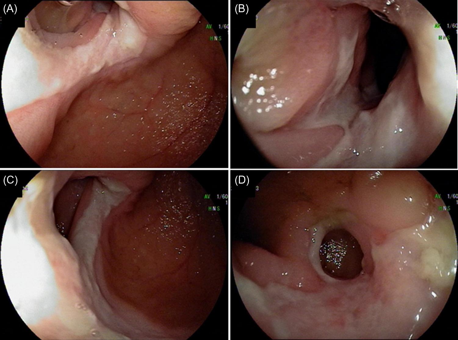 Figure 32.4, Cryptogenic multifocal ulcerous stenosing enteritis. (A–D) Discrete ulcerated strictures in the jejunum and ileum with normal mucosa of the small bowel segments in between.