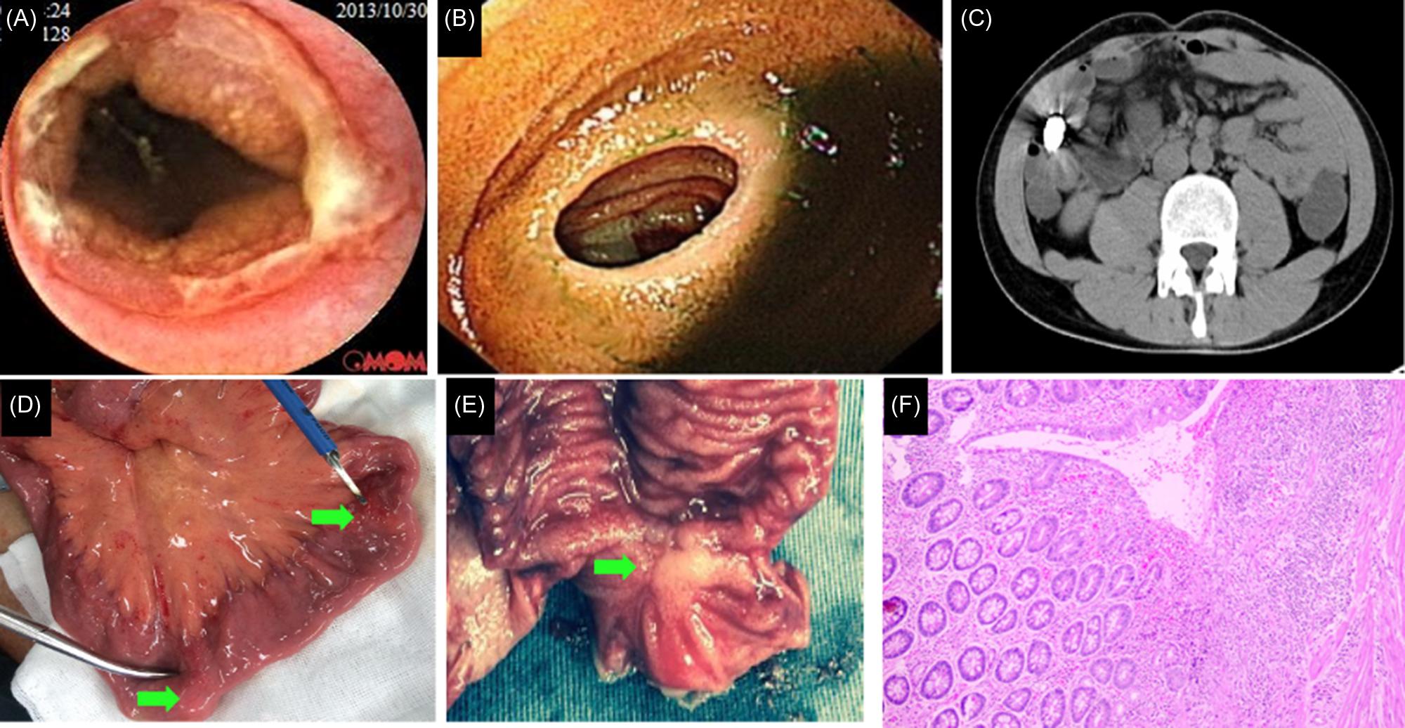 Figure 32.5, Another patient with CMUSE in the jejunum. (A) Ulcerated stricture at the distal jejunum on capsule endoscopy; (B) a thin and circumferential stricture in the proximal jejunum on balloon-assisted enteroscopy; (C) transiently trapped capsule on CT due to the small bowel strictures; (D and E) the small bowel ring-shaped strictures on surgical resection specimen ( green arrows ); and (F) histopathology shows ulceration and infiltration of chronic inflammatory cells in the lamina propria and muscularis mucosae, in the absence of transmural inflammation. CMUSE , Cryptogenic multifocal ulcerous stenosing enteritis.