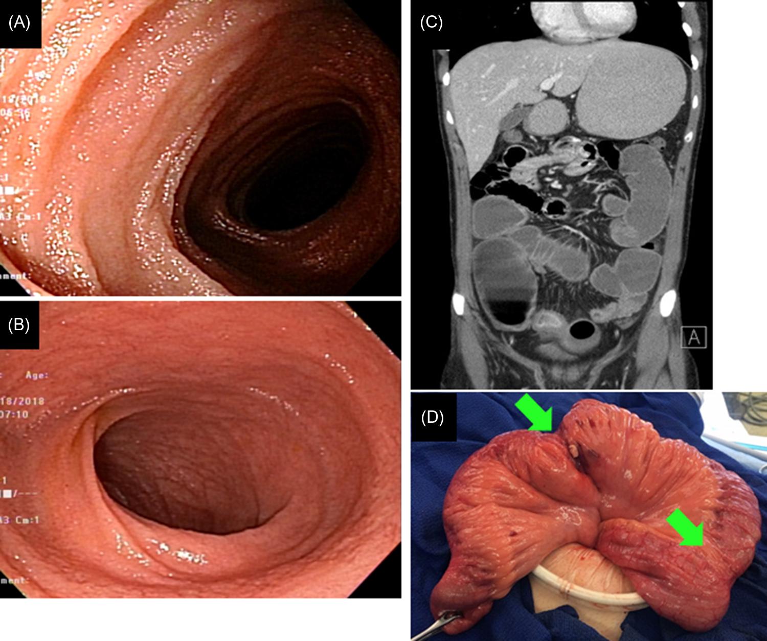 Figure 32.6, CMUSE missed by conventional ileocolonoscopy. The patient was mid-diagnosed as having Crohn’s disease of the small bowel. (A and B) Normal mucosa of the distal ileum; (C) multiple small bowel strictures with dilated small bowel loops in between; and (D) intraoperative photography showed strictured and dilated small bowel ( green arrows ). CMUSE , Cryptogenic multifocal ulcerous stenosing enteritis.