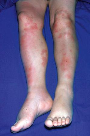 Fig. 10.6, Erythema nodosum: typical erythematous nodule on the shins of a young woman.