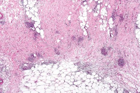 Fig. 10.16, Erythema nodosum: in this example, multiple small granulomata are evident in the thickened septa.