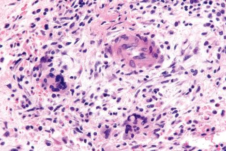 Fig. 10.17, Erythema nodosum: high-power view of granulomata.