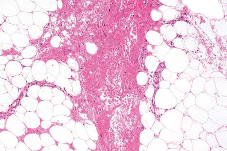 Fig. 10.19, Erythema nodosum: there is marked red cell extravasation.