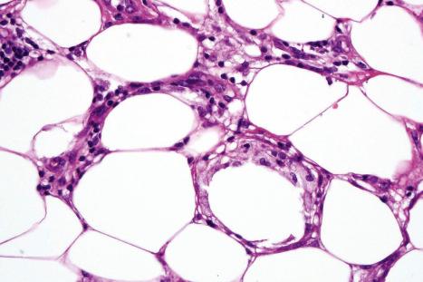 Fig. 10.21, Erythema nodosum: focal fat necrosis associated with lipid-laden histiocytes.