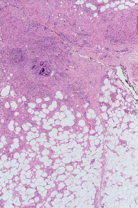 Fig. 10.22, Erythema nodosum migrans: there is marked septal thickening with conspicuous granulomata. Granulation tissue extends into the adjacent lobule.