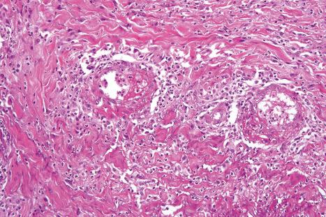 Fig. 10.25, α 1 -Antitrypsin deficiency-associated panniculitis: early lesion showing necrosis and acute inflammation of the deep reticular dermis. Blood vessels are also affected.