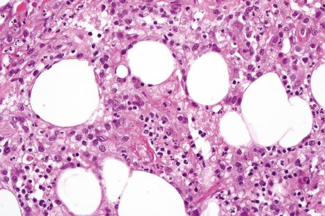 Fig. 10.28, α 1 -Antitrypsin deficiency-associated panniculitis: high-power view showing an intense neutrophil infiltrate.