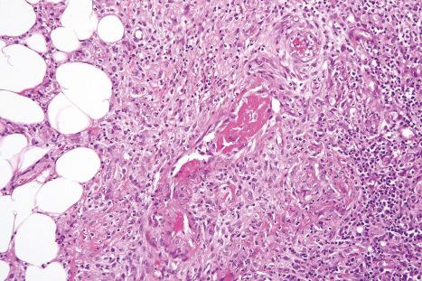 Fig. 10.29, α 1 -Antitrypsin deficiency-associated panniculitis: note the organizing thrombus.