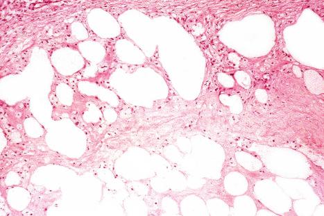 Fig. 10.31, Paraffinoma: empty spaces of variable size (due to the removal of lipid during processing) characterize this lesion. The appearance is often likened to Swiss cheese.