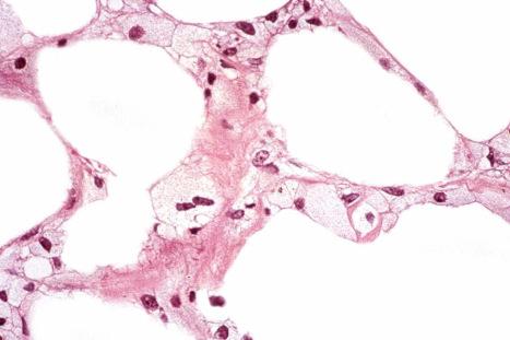 Fig. 10.32, Paraffinoma: on high-power examination, the cystic spaces can often be seen to be lined by lipophages.