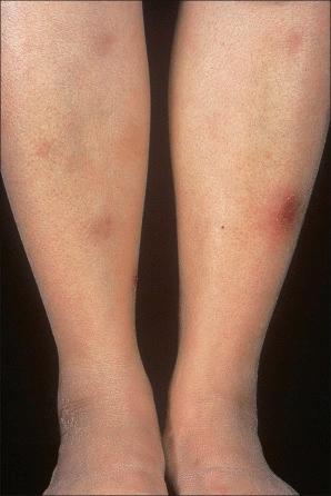 Fig. 10.8, Erythema nodosum: in this patient, the lesions are healing and show a characteristic bruiselike appearance.