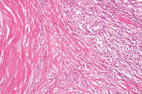 Fig. 10.36, Traumatic fat necrosis: scarring is a feature in more chronic lesions.