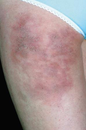 Fig. 10.39, Cold panniculitis: there are ulcerated lesions on this patient's thigh.