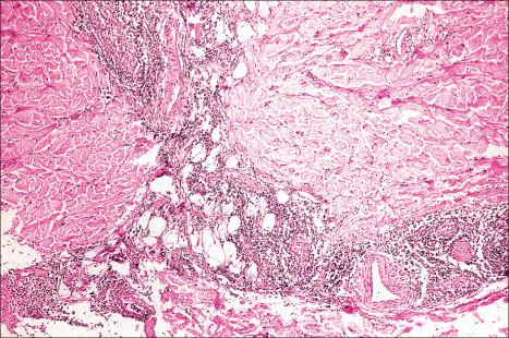 Fig. 10.40, Cold panniculitis: an intense inflammatory cell infiltrate is present at the junction between the dermis and subcutaneous fat.