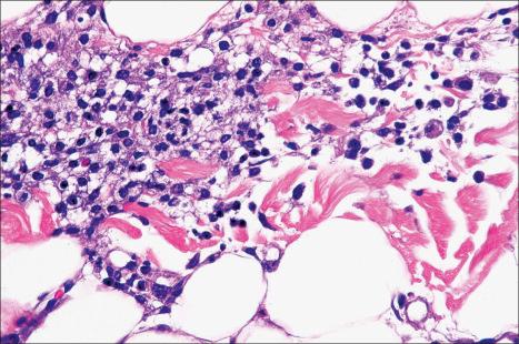 Fig. 10.41, Cold panniculitis: the infiltrate consists of lymphocytes and histiocytes.