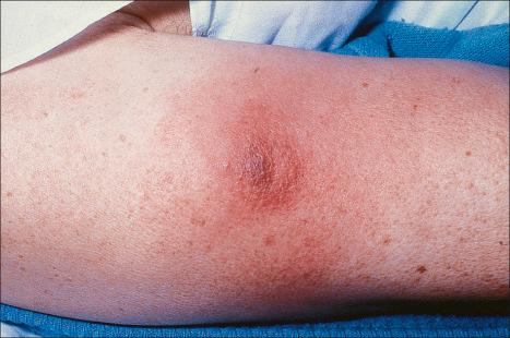 Fig. 10.42, Cytophagic histiocytic panniculitis: an extensive, erythematous, indurated plaque is present on the upper arm.