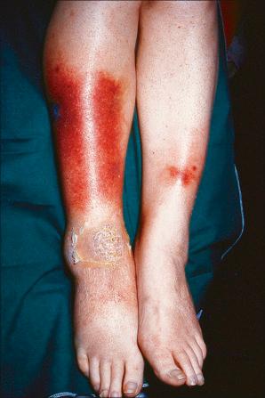 Fig. 10.43, Cytophagic histiocytic panniculitis: in this example the lesions are hemorrhagic and ulcerated.