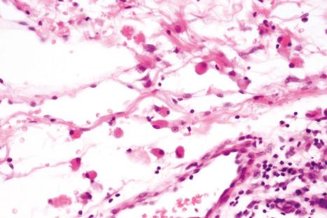 Fig. 10.45, Cytophagic histiocytic panniculitis: note the histiocytes with abundant eosinophilic cytoplasm, some of which show erythrophagocytosis.