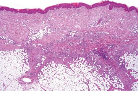 Fig. 10.9, Erythema nodosum: this example shows the classical appearance of septal inflammation with spread into the immediately adjacent lobule, giving rise to a lacelike appearance.