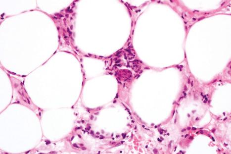 Fig. 10.46, Cytophagic histiocytic panniculitis: in the center of the field are several multinucleated giant cells containing phagocytosed nuclear debris (‘bean-bag’ cells).