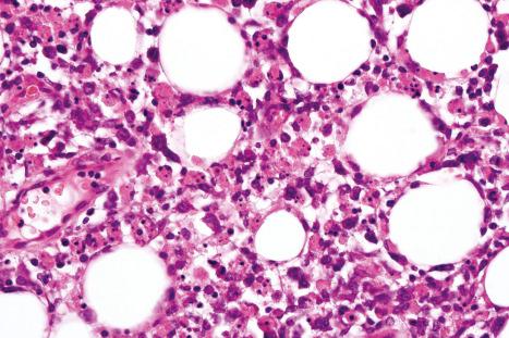 Fig. 10.47, Subcutaneous panniculitic T-cell lymphoma: numerous histiocytes showing hemophagocytosis are present. In addition, however, there are conspicuous hyperchromatic and irregular atypical lymphocytes.