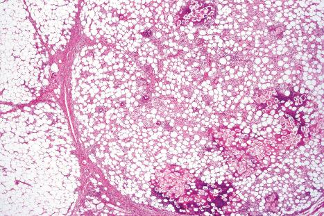 Fig. 10.51, Pancreatic panniculitis: the changes predominantly affect the lobules.