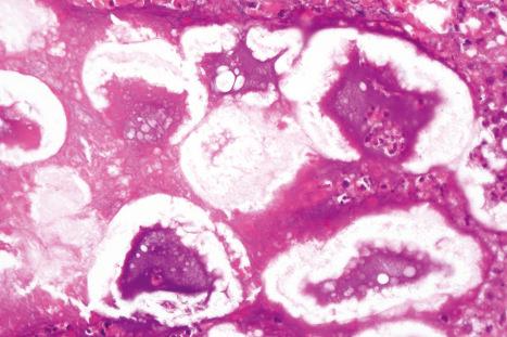 Fig. 10.54, Pancreatic panniculitis: the stippled basophilia represents calcification.