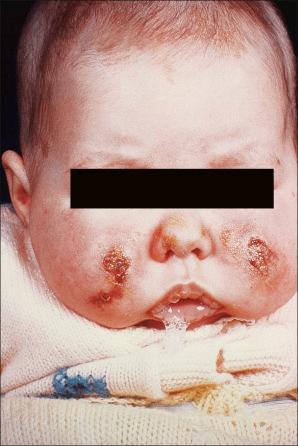 Fig. 10.57, Subcutaneous fat necrosis of the newborn: crusted, ulcerated nodules on both cheeks.