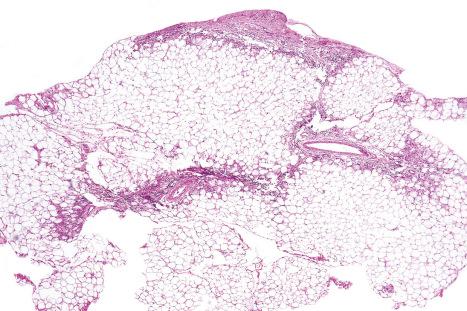 Fig. 10.58, Subcutaneous fat necrosis of the newborn: multiple foci of fat necrosis with chronic inflammation are present.