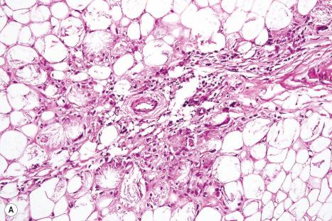 Fig. 10.59, ( A , B ) Subcutaneous fat necrosis of the newborn: individual adipocytes are swollen and contain characteristic, radial, eosinophilic crystals.