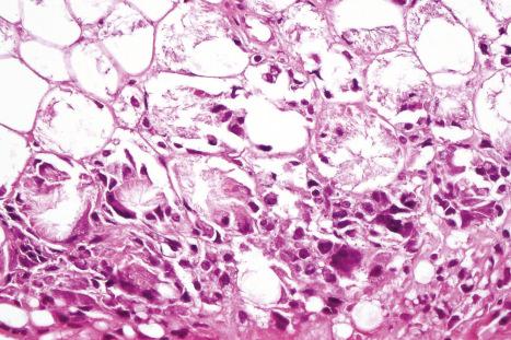 Fig. 10.60, Subcutaneous fat necrosis of the newborn: surrounding the foci of fat necrosis is a chronic inflammatory infiltrate containing numerous foreign body giant cells.