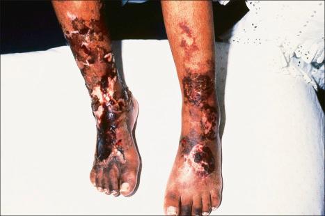 Fig. 10.61, Cutaneous oxalosis: this child shows gangrene with ulceration.