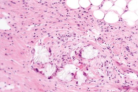 Fig. 10.62, Cutaneous oxalosis: note the radially orientated, needle-shaped crystals.