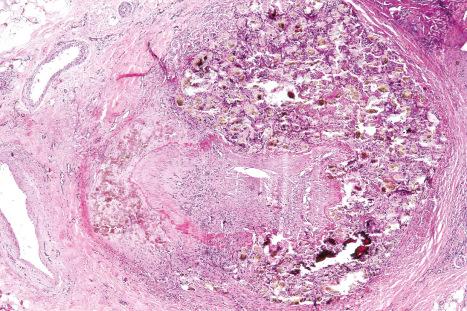 Fig. 10.64, Cutaneous oxalosis: in this field there is dramatic vascular involvement with destruction of the media and massive intimal thickening.