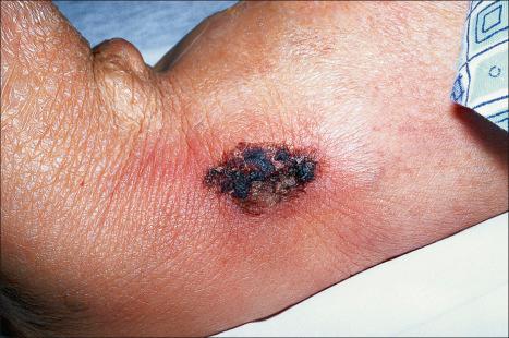 Fig. 10.65, Calciphylaxis: ulcerated gangrenous lesion with surrounding erythema.