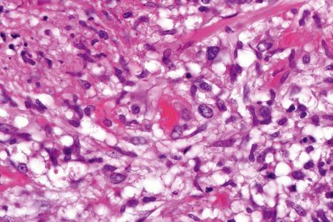 Fig. 10.11, Erythema nodosum: in this field there is a thrombosed venule associated with marked hemorrhage.