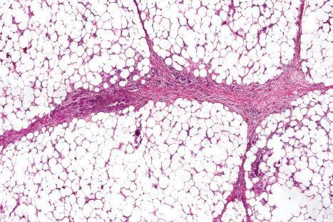 Fig. 10.66, Calciphylaxis: there is focal fat necrosis and widespread calcification affecting the small vessels. Note the thickened and fibrosed septa.