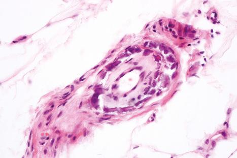 Fig. 10.69, Calciphylaxis: in addition to mural calcification, there is marked intimal fibroblastic proliferation.