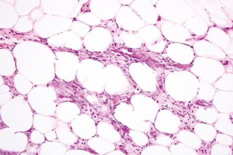 Fig. 10.70, Calciphylaxis: fat necrosis with conspicuous lipophages. In addition, there is widespread calcification.