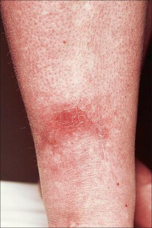 Fig. 10.71, Nodular vasculitis: early lesion presenting as an erythematous nodule on the calf of a middle-aged female.