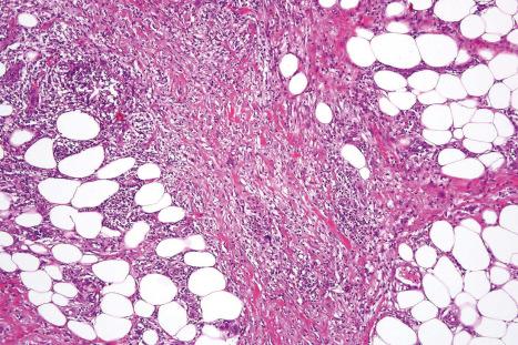 Fig. 10.12, Erythema nodosum: there is septal thickening with a lymphohistiocytic infiltrate.