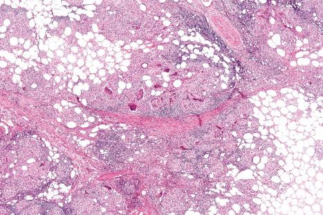 Fig. 10.76, Nodular vasculitis: note the distinct nodules of granulomatous inflammation at the periphery of the lobule.