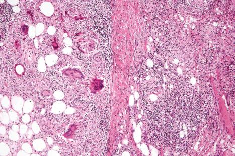 Fig. 10.77, Nodular vasculitis: well-formed epithelioid granulomata and multinucleate giant cells are present.