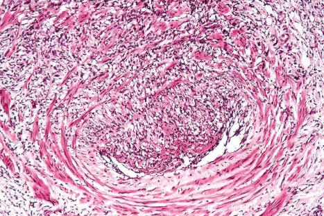 Fig. 10.78, Nodular vasculitis: vascular involvement as seen in this field is a characteristic feature.