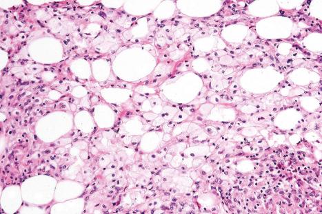Fig. 10.79, Nodular vasculitis: note the presence of numerous lipophages.