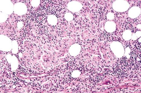 Fig. 10.81, Nodular vasculitis: granulomata may be seen within the lobule and also in the septa.