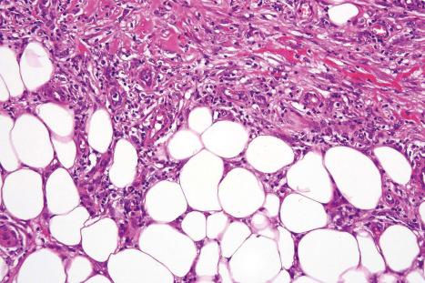 Fig. 10.13, Erythema nodosum: this view shows the interface between the septum and the lobule.